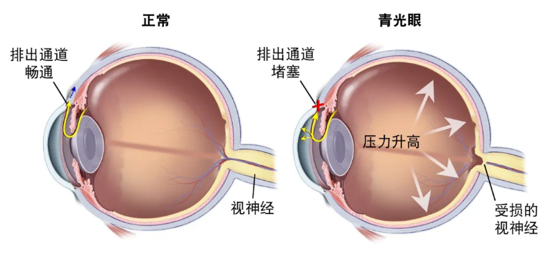 Glaucoma 適逢世界青光眼週「視力小偷」青光眼知多少？