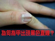 Nails 為何指甲出現黑色直線？了解縱向黑甲症的成因