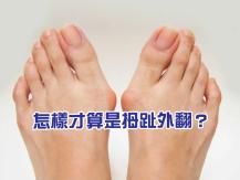 Hallux Valgus 你有拇趾外翻的煩惱嗎？ 日本醫師推介「腳趾彎曲體操」