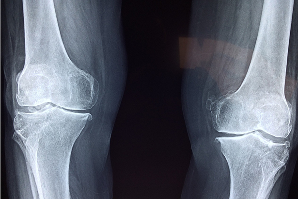 骨質疏鬆是年長人士的常見症狀，主因是體質流失，令骨骼變得脆弱，於是容易發生骨折。(Photo by Pixabay)
