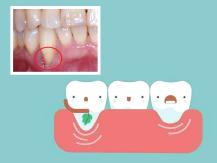Dental Health 4 月牙齒健康月 刷牙不當小心牙齦萎縮