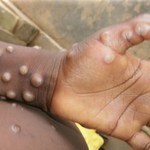 Monkeypox 猴痘 （粵語） 